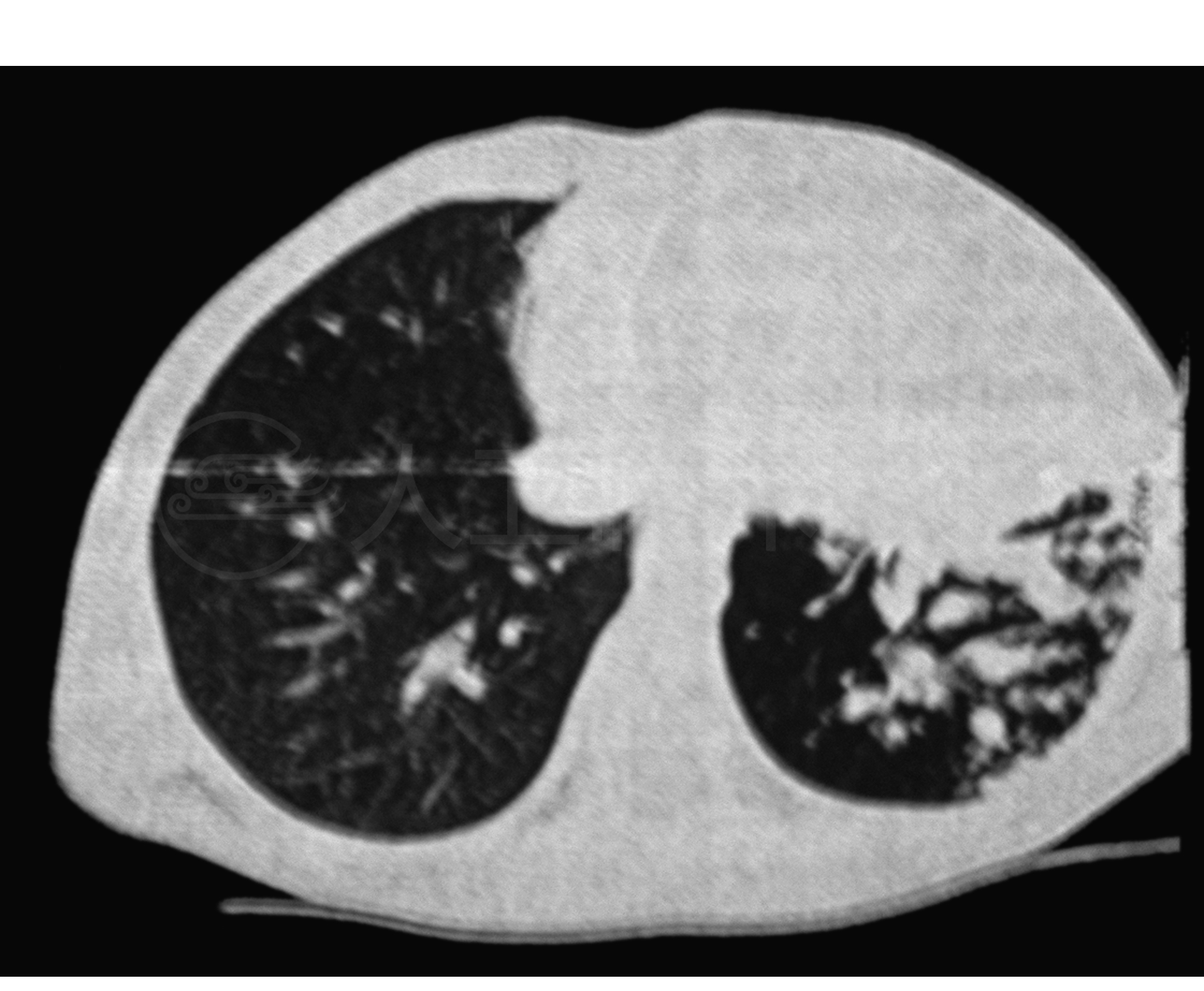 Ct 肺炎